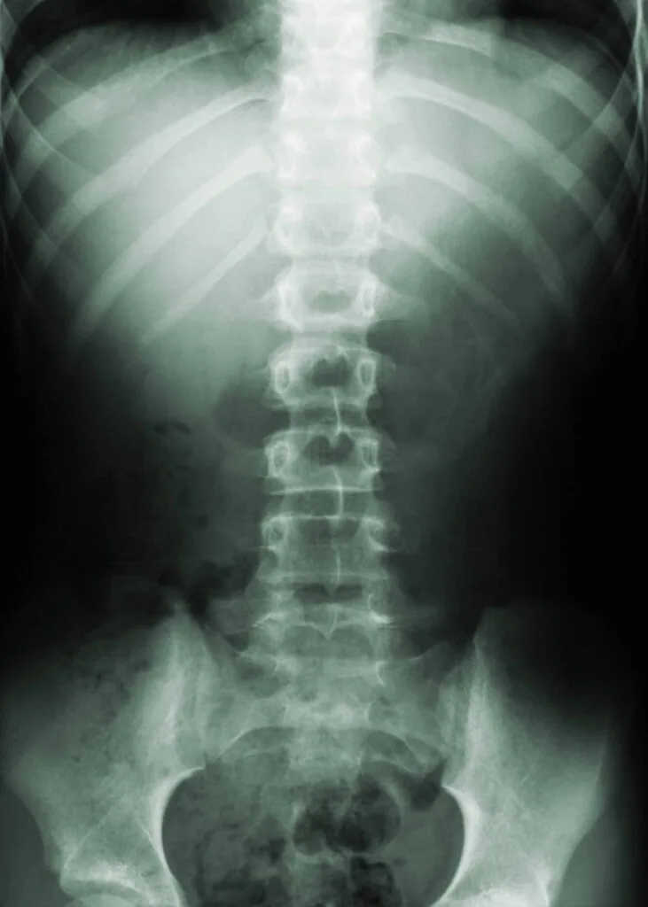 X-ray of the spine showing thoracic and lumbar vertebrae with pelvis